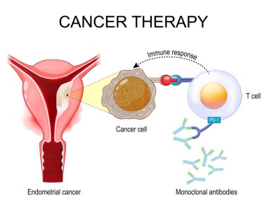 Endometriyal kanser terapisi. İnsan rahminde tümörlü bir kesit. Endometriyal Kanser Tedavisinde Monoklonal Antikorlar. Kanser önleyici ilaçlar. Vektör illüstrasyonu