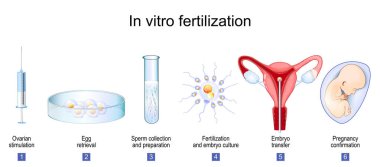 Döllenme. Damar yolu ameliyatının basamakları. Yumurtalık stimülasyonu, yumurta alma, sperm toplama ve hazırlama, döllenme ve embriyo kültürü, embriyo transferi ve hamilelik onayı. Kısırlık tedavisi. Üreme tıbbı. Vektör illüstrati