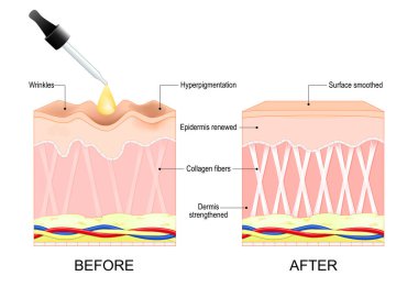 Retinol nasıl çalışıyor. Retinol tedavisinden önce ve sonra deri değişir. Kozmetik prosedür önleniyor. Vektör illüstrasyonu