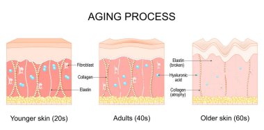 Yaşlanma süreci. Gençlerin, yetişkinlerin ve yaşlanmış ciltlerin karşılaştırılması. Kolajen fiberleri köreldiğinde ciltte yaşla ilgili değişiklikler oldu. Elastin kırıldı. Vektör illüstrasyonu