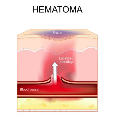 Hematom. Çürük ve lokal kanama. Damar hasarı üstüne kan damarı. İnsan derisinin çapraz kesimi. Vektör illüstrasyonu