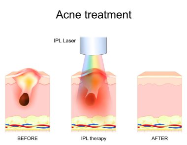 IPL terapisi. Sivilce tedavisi. Yoğun titreşimli ışık prosedüründen önce ve sonra deri. Cilt temizleme. terapi dalgaboyları. Vektör illüstrasyonu