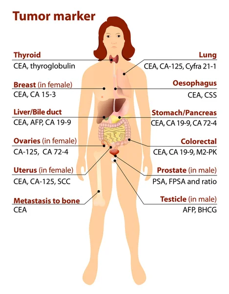 Marcador tumoral. Cáncer — Vector de stock