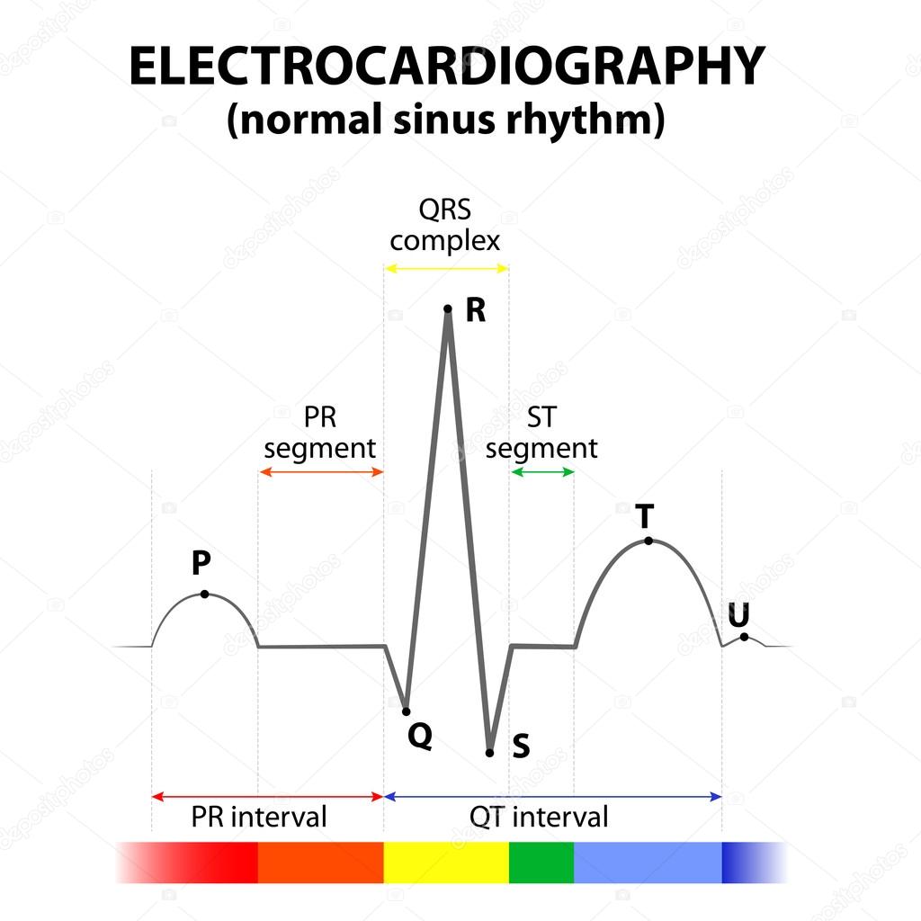 ECG of a heart in normal sinus rhythm