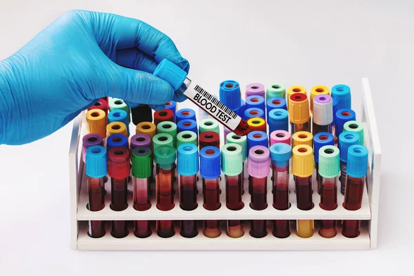 Лікар Пробіркою Крові Аналізу Лабораторії Технік Тримає Пробірку Крові Аналізу — стокове фото
