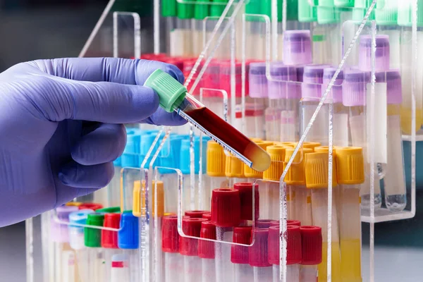 Hastanenin Kan Bankası Laboratuvarında Kan Örneği Tüpü Olan Bir Teknisyen — Stok fotoğraf