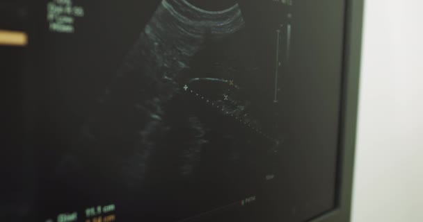 Sonografi. Skärmen på ultraljudsmaskinen. Resultaten av ultraljudet på monitorn. Sjukvårdskoncept. Ultraljuds maskinskärm. Läkaren gör mätningar på datorskärmen — Stockvideo