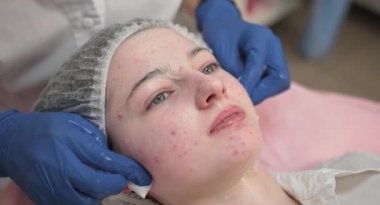 Mavi lastik eldivenli kozmetolojistin ellerini kapayarak genç kızların yüzüne profesyonel köpük soyarak ya da temizleyerek. Modern klinikte sivilce ve sivilce tedavisi. Cilt bakımı kavramı