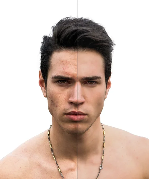 Man Face with Pimple and Flawless Sides — kuvapankkivalokuva