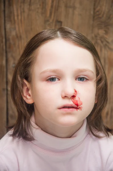 Девочка, истекающая кровью из носа — стоковое фото