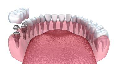 3D alt dişler ve diş implantı şeffaf izole üzerinde beyaz render