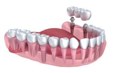 3D alt dişler ve diş implantı şeffaf izole üzerinde beyaz render