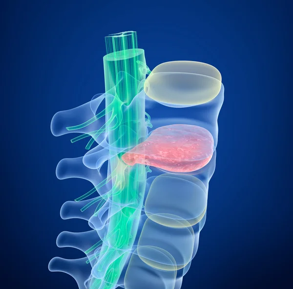 Spinal cord under pressure of bulging disc, XRay view. 3D rendering