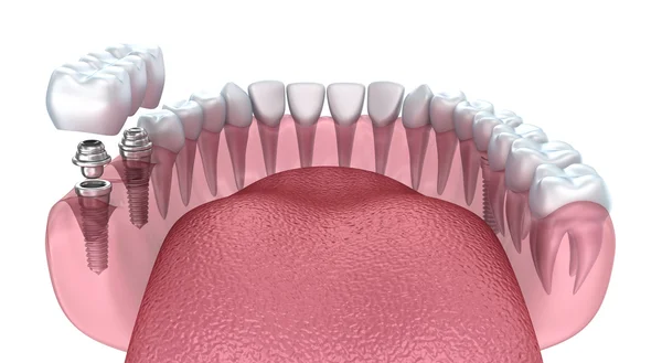 3D alt dişler ve diş implantı şeffaf izole üzerinde beyaz render — Stok fotoğraf