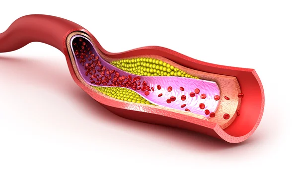 Cholesterol plaque in blood vessel, illustration — Stock Photo, Image
