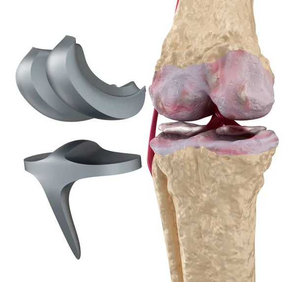 Knie en titanium scharnier joint. geïsoleerd op wit — Stockfoto