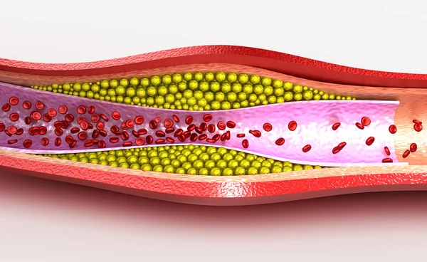 Tablica cholesterolu w naczynie krwionośne, ilustracja — Zdjęcie stockowe