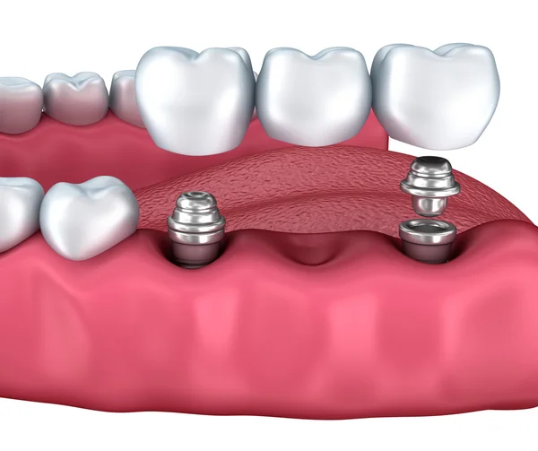 3d dientes inferiores e implante dental aislado en blanco —  Fotos de Stock