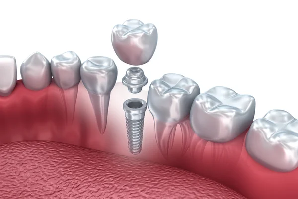 İnsan diş implantı, 3d çizim — Stok fotoğraf