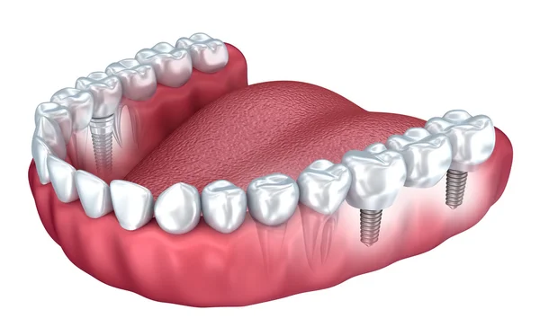 3d dientes inferiores e implante dental aislado en blanco —  Fotos de Stock