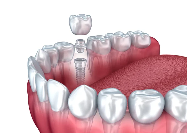 3d dentes inferiores e implante dentário isolado em branco — Fotografia de Stock