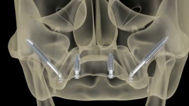 Elmacık kemiği implantları tarafından desteklenen Maxillary protezi. İnsan dişlerinin ve protezlerinin tıbbi açıdan doğru üç boyutlu animasyonu