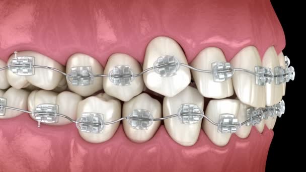 Position anormale des dents et correction avec un traitement clair des accolades. Animation 3D dentaire médicalement précise — Video