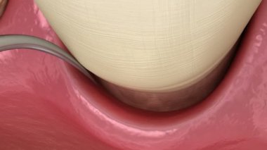 Lazer kanı sertleştiriyor. Diş tedavisinin tıbbi açıdan doğru olan 3D animasyonu