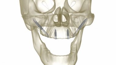 Elmacık kemiği implantları tarafından desteklenen Maxillary protezi. İnsan dişlerinin ve protezlerinin tıbbi açıdan doğru üç boyutlu animasyonu