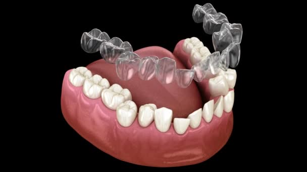 Invisaligne Zahnspangen oder unsichtbare Halter führen zur Bisskorrektur. Medizinisch korrekte 3D-Animation — Stockvideo