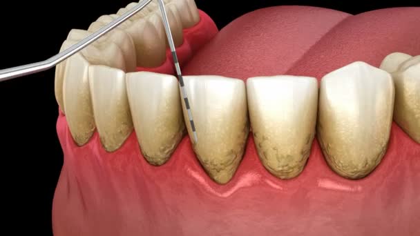 歯周炎の検査、歯茎の退縮プロセス。医学的に正確な3Dアニメーション — ストック動画