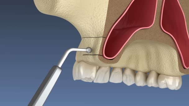 Cirugía de elevación sinusal con acceso lateral. Animación 3D de cirugía dental — Vídeos de Stock