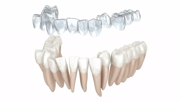 Diş telleri ya da görünmez diş telleri ısırık düzeltmesini sağlar. Tıbbi olarak doğru 3B canlandırma — Stok video