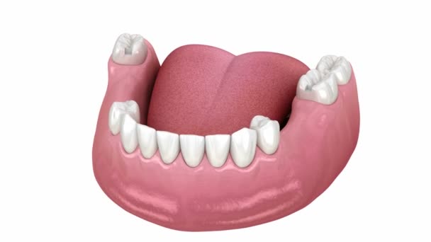 Prothèse partielle amovible, prothèse mandibulaire. Animation 3D médicalement précise du concept de prosthodontie — Video