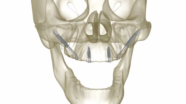 Prótesis maxilar apoyada por implantes cigomáticos. Animación 3D médicamente precisa de dientes humanos y dentaduras postizas — Vídeos de Stock