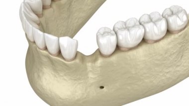 Artırma Cerrahisi - Yeni kemik ve implant ekleniyor. 3 Boyutlu Canlandırma