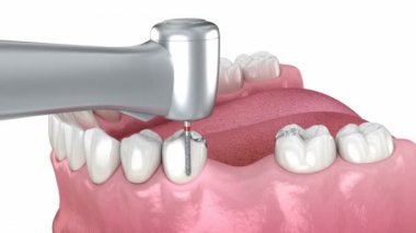 Amalgam kaldırılıyor ve seramik köprü yerleştirme için hazırlanıyor. Tıbbi olarak doğru 3B canlandırma