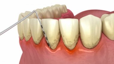 Periodontit testi, sakız resesyonu. Tıbbi olarak doğru 3B canlandırma