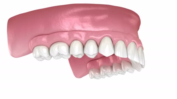 Prótese maxilar Todos em 4 sistema suportado por implantes. Animação 3D medicamente precisa do conceito de dentes humanos e dentaduras — Vídeo de Stock