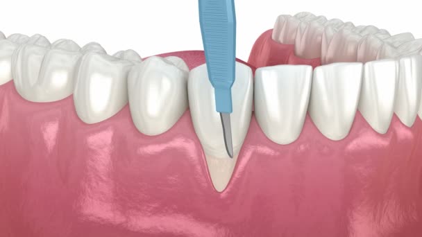 Recessão de gengiva: cirurgia de enxerto de tecidos moles. Animação 3D do procedimento odontológico — Vídeo de Stock