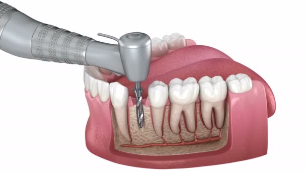 Отсутствие восстановления зубов с помощью имплантата: 3D анимация сверления, установка имплантата, опора и фиксация коронки — стоковое видео