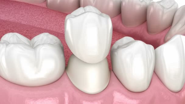 Elkészített preoláris fog fogászati kerámia korona elhelyezésére. Orvosilag pontos 3D animáció — Stock videók