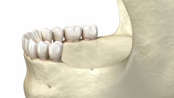 Střih alveolárního hřebene, augmentace, implantace. Zubní chirurgie, 3D animace. — Stock video