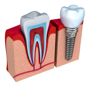 sağlıklı dişler ve diş implant çene kemiği anatomisi.