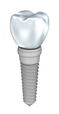 alt dişler ve Diş implantları üzerine beyaz izole yakından görmek