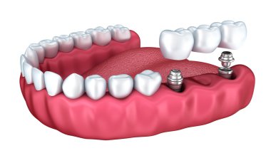 Diş implantları, kron ve üzerinde beyaz izole pimleri