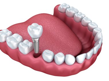 Diş implantları, kron ve üzerinde beyaz izole pimleri