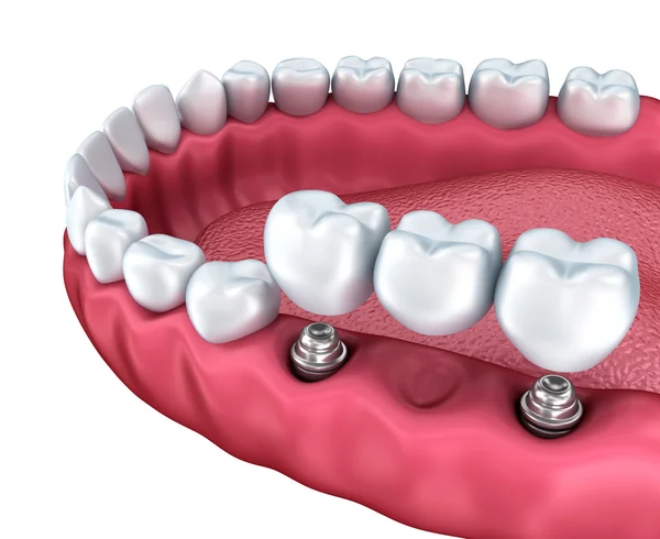 Implantes dentários, coroas e pinos isolados sobre branco — Fotografia de Stock