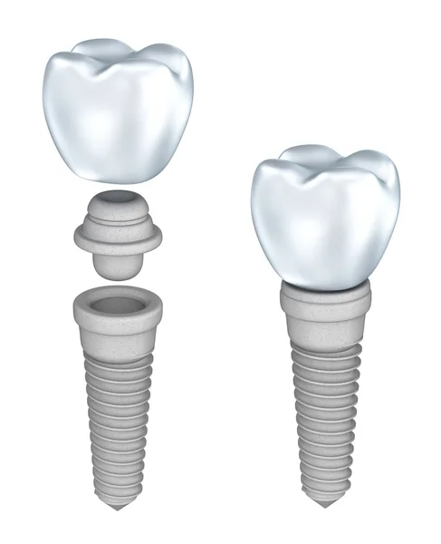 Dental implant isolated on white — Stock Photo, Image