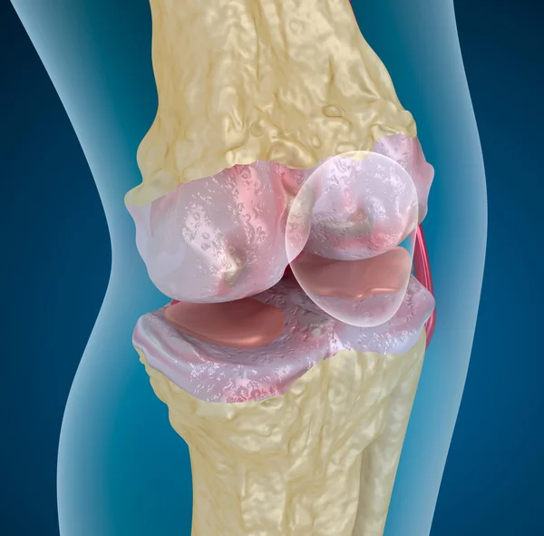 Osteoporosis de la articulación de la rodilla — Foto de Stock